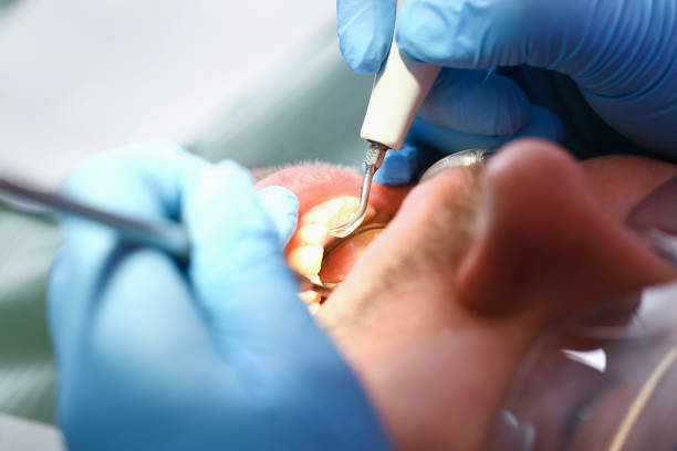 Best Emergency Tooth Extraction in Grandview, TX